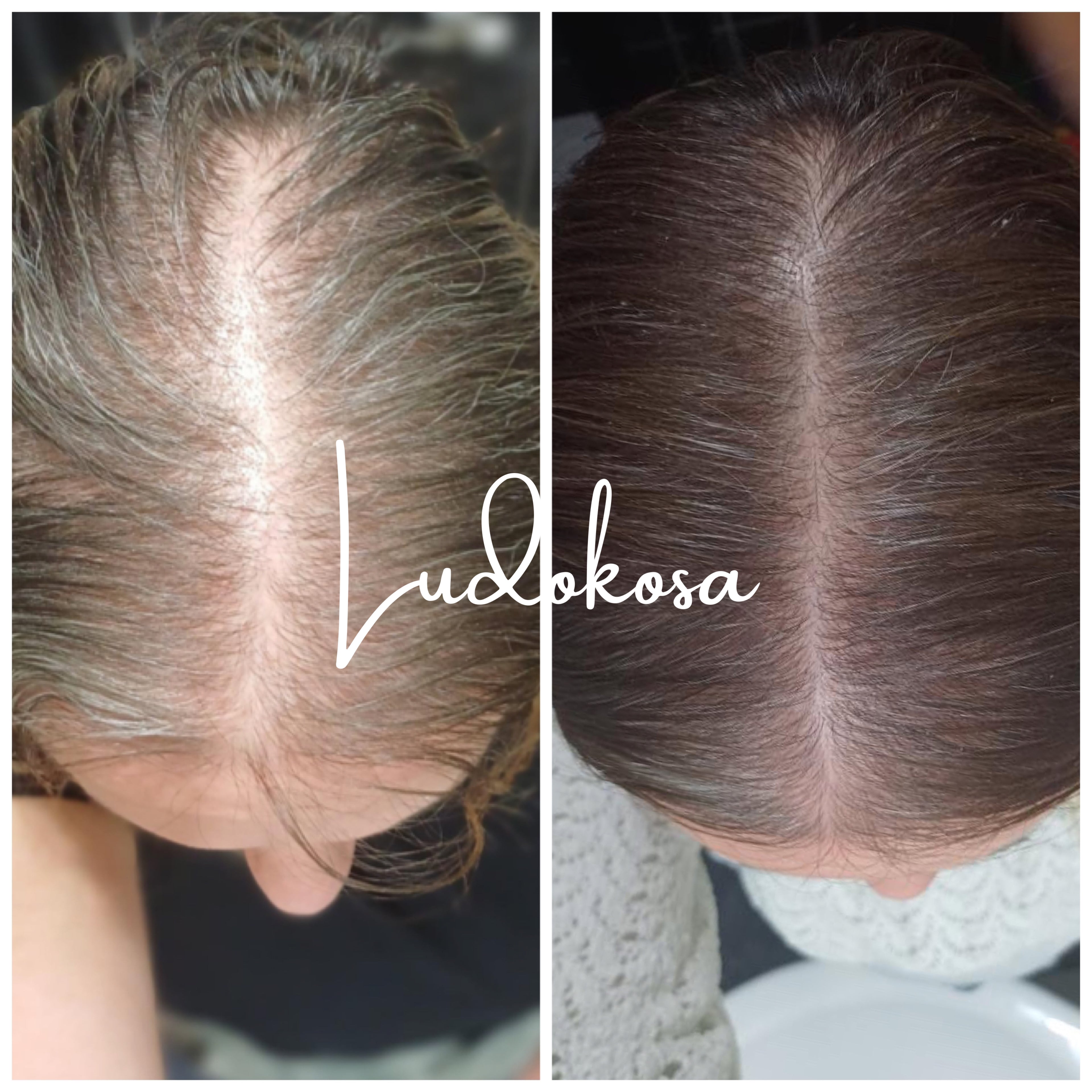 Rezultai plana nege kod androgene alopecije pre i posle